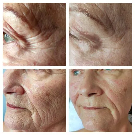 Goldfaden behandlung