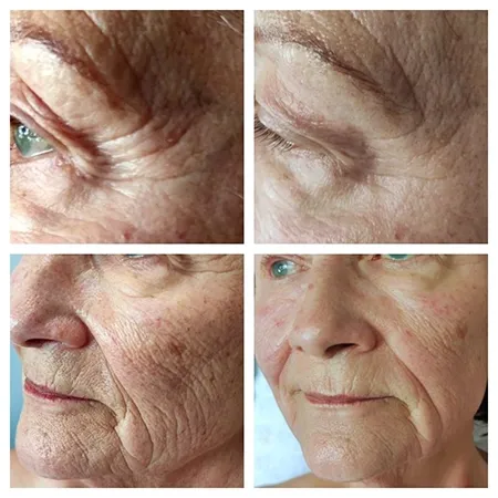 nofretete behandlung