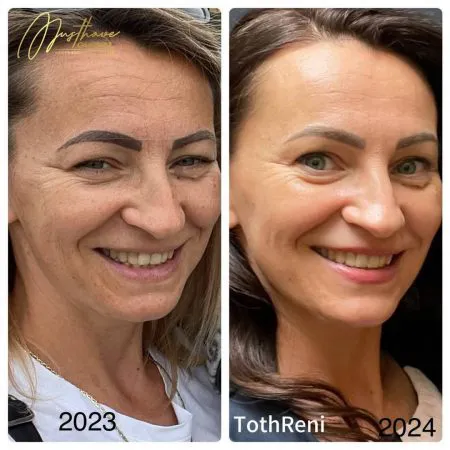 Goldfaden behandlung