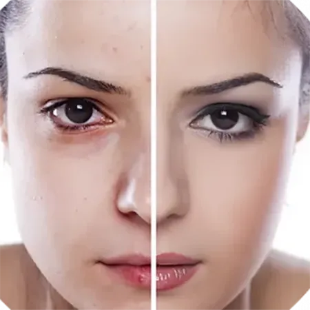 Unreine Haut Akne Behandlung